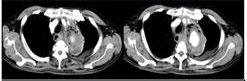 (B) Contrast-CT.